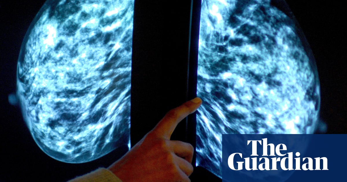 NHS to launch world’s biggest trial of AI breast cancer diagnosis - Today news