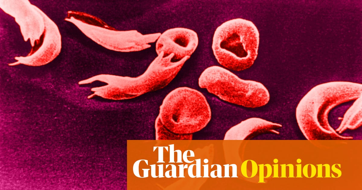 This new sickle cell treatment could be a gamechanger – if the NHS really starts to care about black people’s health | Tobi Oredein - Today news